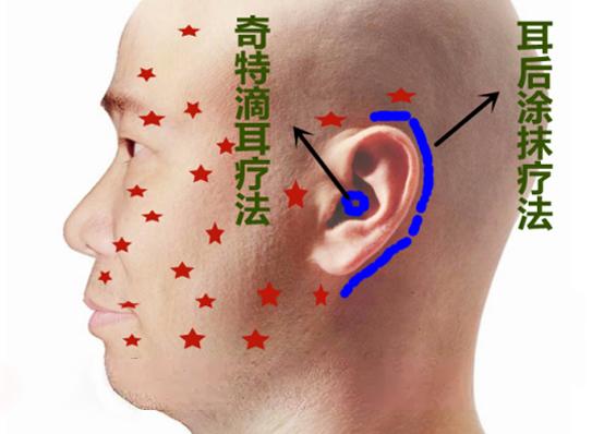 三叉神经痛的治疗(图1)