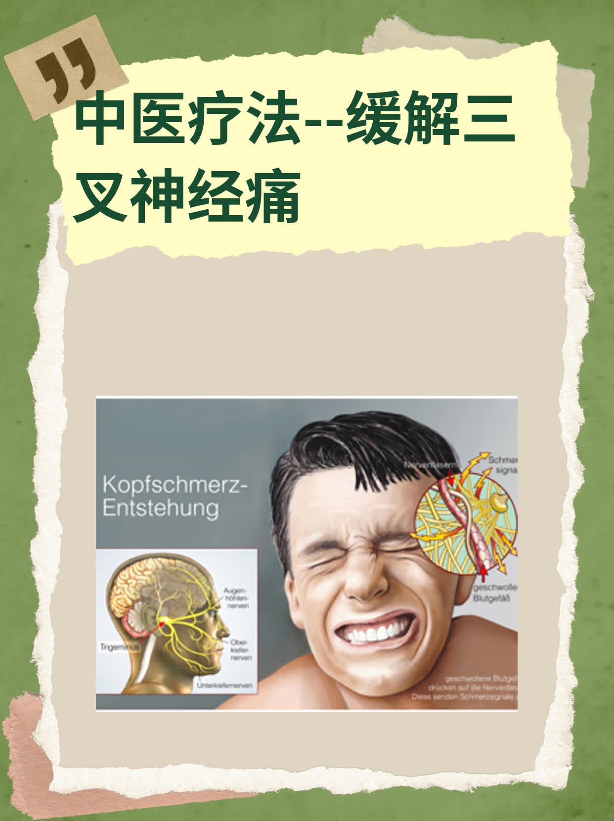 三叉神经痛治疗新进展(图1)